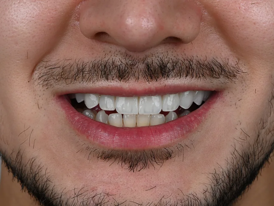 Patient smile after treatment at Tam Dental