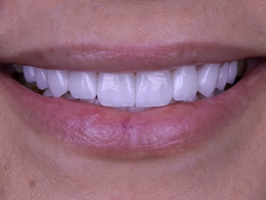 Patient smile after treatment at Tam Dental