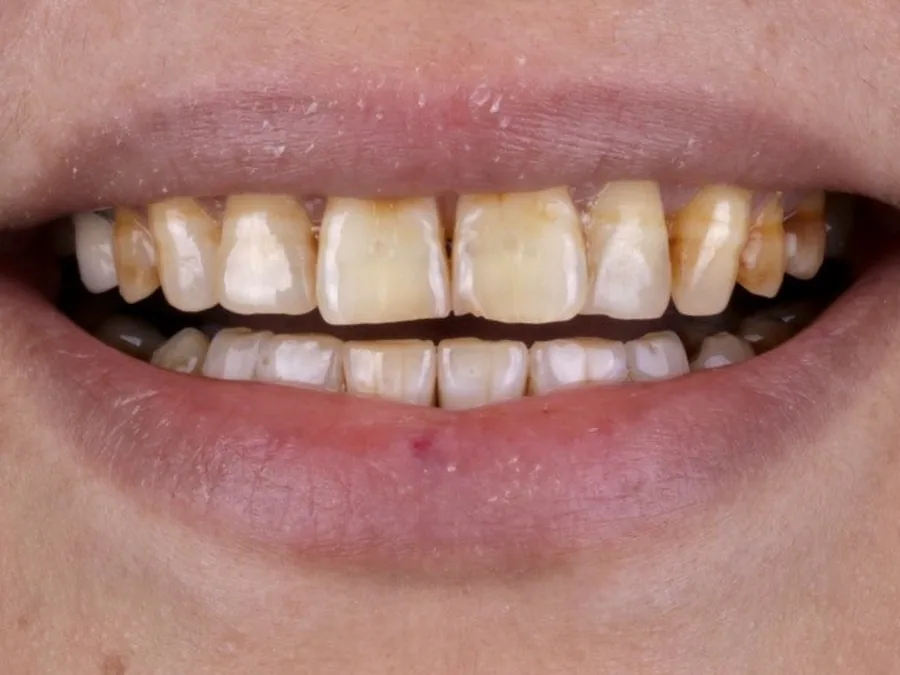 Patient smile before treatment at Tam Dental